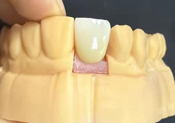 Тістер арасындағы саңылауларды түзетуге болады — түзу тістер ең тартымды!