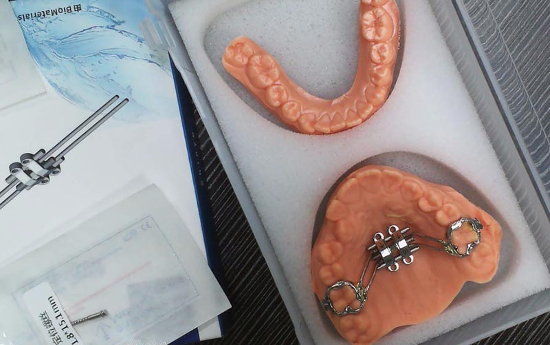 WM Dental Lab көмегімен MSE скелеттік кеңеюін түсініңіз