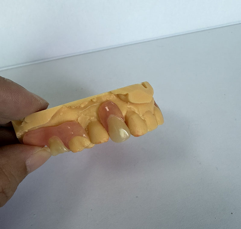 WM Dental Lab-да Valplast Partals